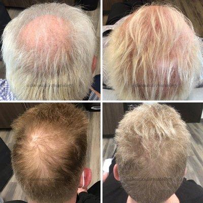 PRP for Hair Loss