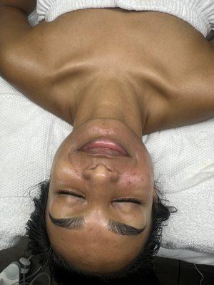 Acne Facial