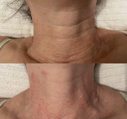 Before and After HIFU Treatment