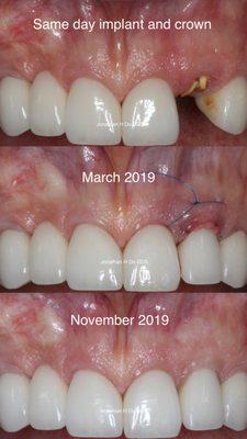 Same day/immediate implant and crown