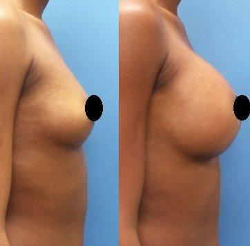 Breast Augmentation in Chicago.  Sientra High Profile Round Implants.