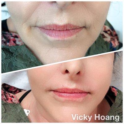 Hyaluronic Acid filler. No needles need, painless