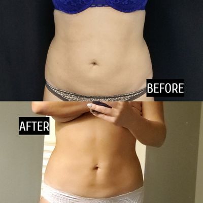 Coolsculpting and emsculpt combo treatment