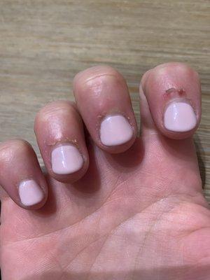 Hangnails after the manicure