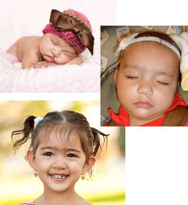 Cleft Lip & Palate Repair Surgery