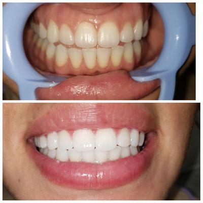 1 hour Teeth Whitening-$150