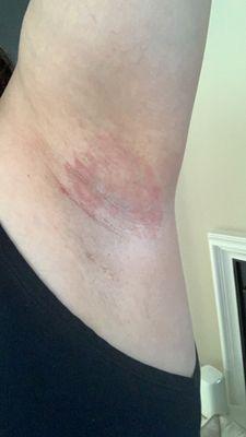 Burned under arm due to horrible waxing jobs by so called estheticians!