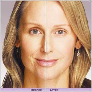 Juvederm