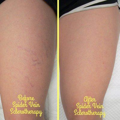 The leg spider veins were treated with Sclerotherapy by Dr. Raffi Dishakjian at Nu Vela.