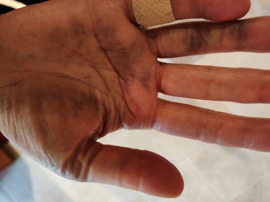 Bruising of hand (not dirt)