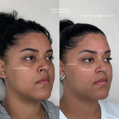 Under eye Correction