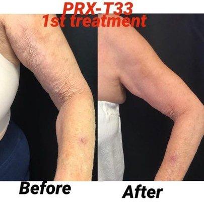 Before and After pictures of our most newest Treatment !