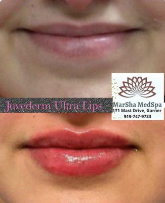 Natural Volume to lips! Book a consultation at 919-747-9733