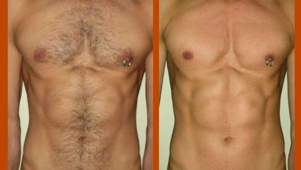 Before and after full chest,full stomach wax