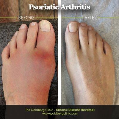 Psoriatic Arthritis Before and After