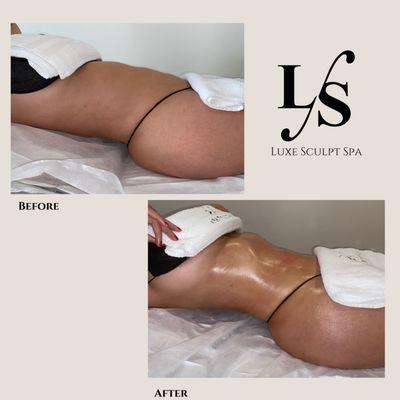 Before and After a Non - Invasive Body Sculpting massage at Luxe Sculpt Spa