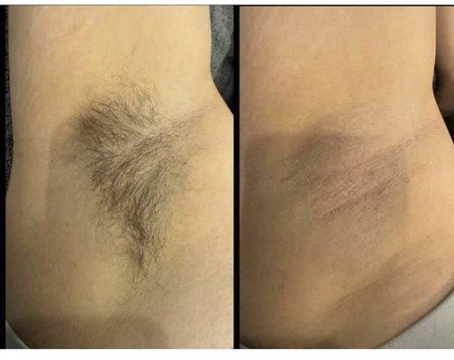 Depilación de axilas (underarms)con cera