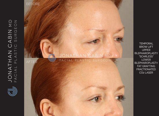 1 year post-op from full upper facial rejuvenation including brow lift, upper and lower eyelid lift, fat grafting and CO2 laser resurfacing.