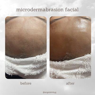 microdermabrasion treatment before & after