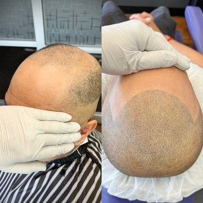 Before & After Scalp Micro Pigmentation.