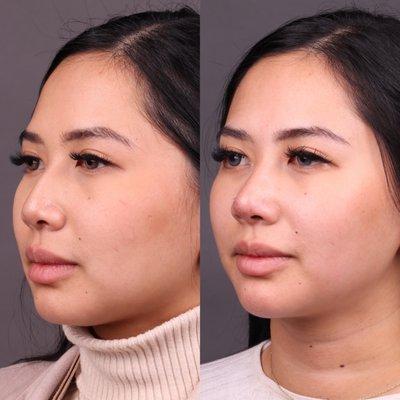 Liquid rhinoplasty