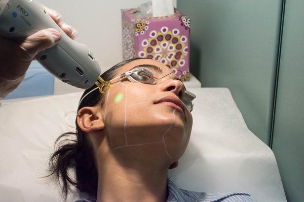 Laser Rejuvenation Facial - Ideal for Skin Tightening, Pore size reduction, and uneven skin tone. Safe for all skin types and NO downtime!