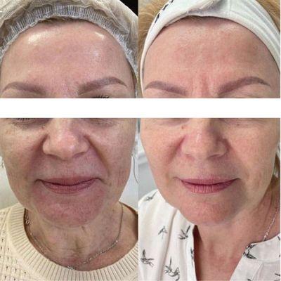 RF Skin Tightening Facial