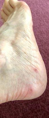 Cuts from pedicure