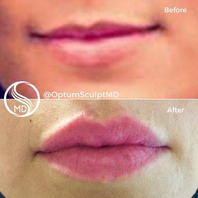 Lip Augmentation