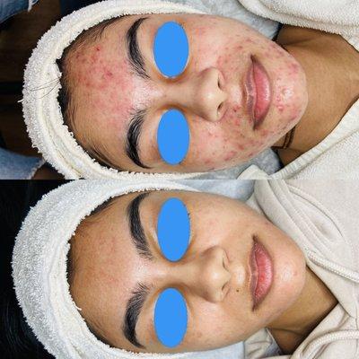 Before and After acne program