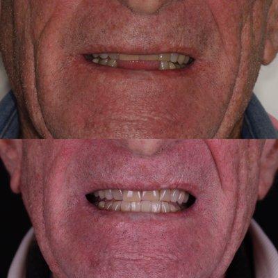 Dental Implants for Missing Teeth. Patient can finally eat again!