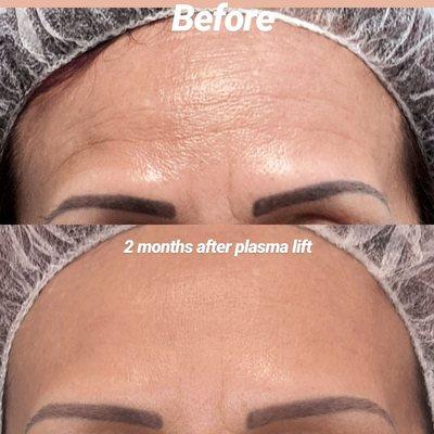 Plasma lift results