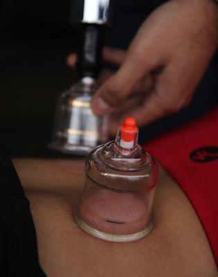 Cupping Therapy