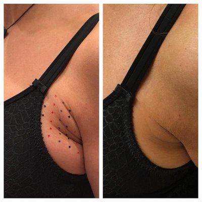 Kybella treatment