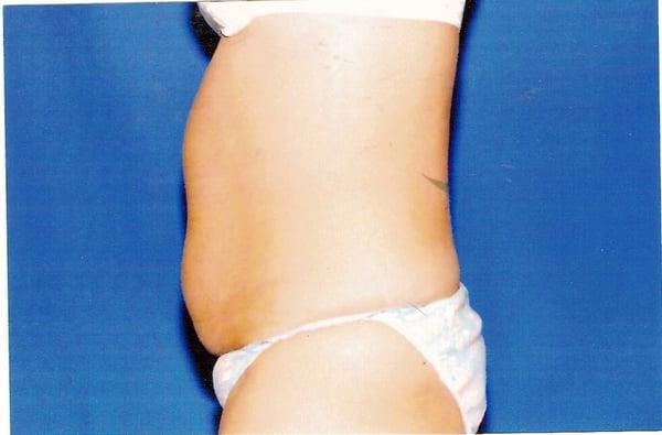 Liposuction side view Before