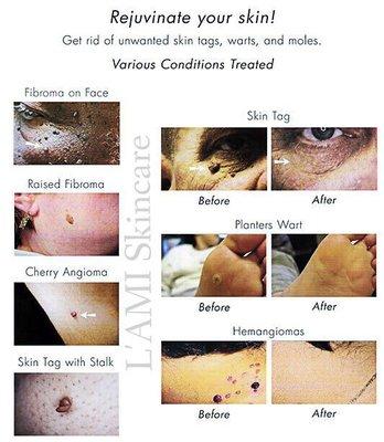 L'AMI Skincare specializes in irregular skin growth removal.