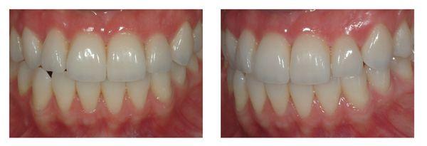 Veneers with a bright, fresh,  youthful, and natural appearance.