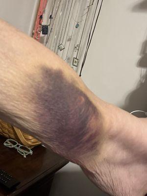 Three days after oral surgery, my forearm from blown vein.