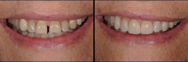 Smile lift by Dr. Tracey Nguyen, Accredited Member of the American Academy of Cosmetic Dentistry