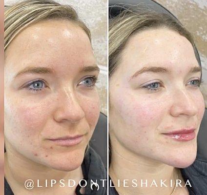 We worked on balancing her profile and worked on jawline and chin-building the house!! We placed her on medical grade skincare.