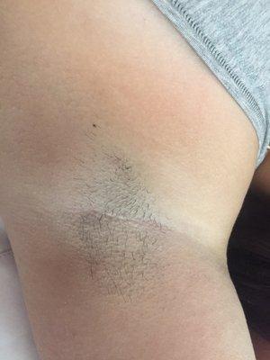 One of our first time client's laser hair removal treatments before Laser was done