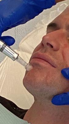 Microneedling with PRP.