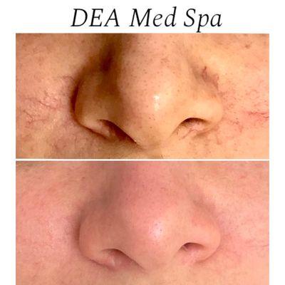 Laser facial vein removal