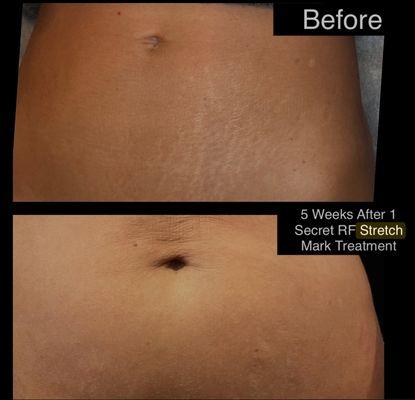 Stretch Mark Treatments