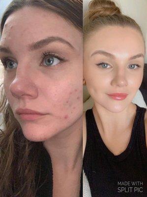 Acne treatment before/ after.