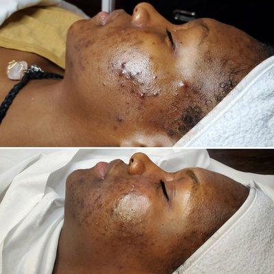 Before and after several acne treatments and at home skincare protocols.