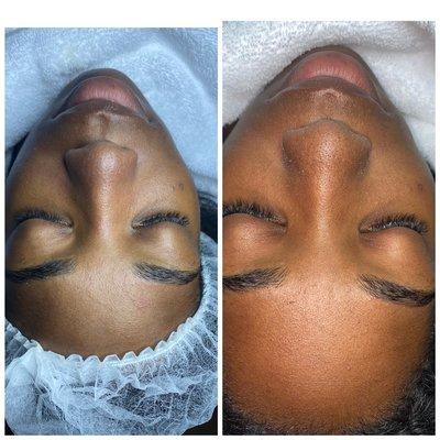 Before and after a Hydro Facial, extractions we're done removal of visible whiteheads.