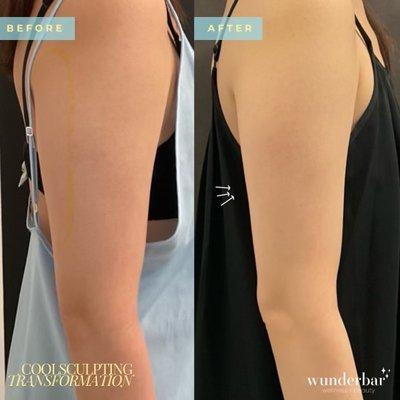 Coolsculpting Elite (arms)