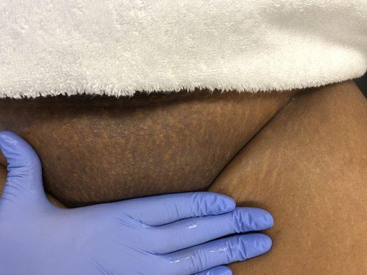 Brazilian sugaring