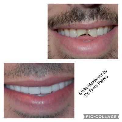 "See the power of what a Smile Makeover can do for your smile!" Request a Free Consultation today! https://www.tempearizona.dentist/appointm